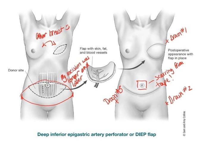 Medical diagram of flap procedure